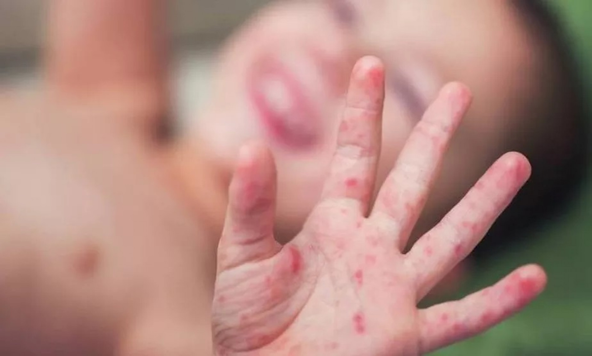 As erupções cutâneas estão entre os sintomas principais