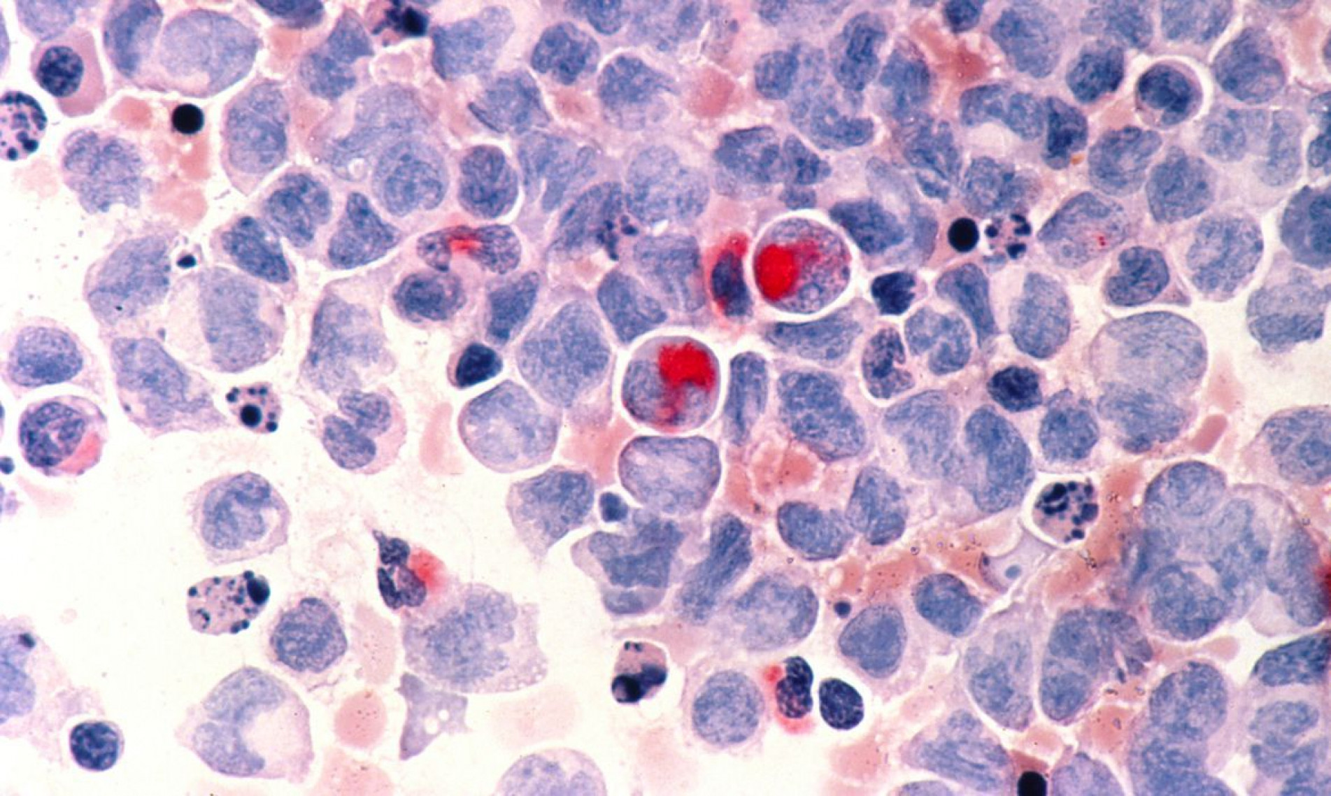 Na terapia CAR-T Cell as células T do paciente são alteradas em laboratório para reconhecer e atacar as células cancerígenas 