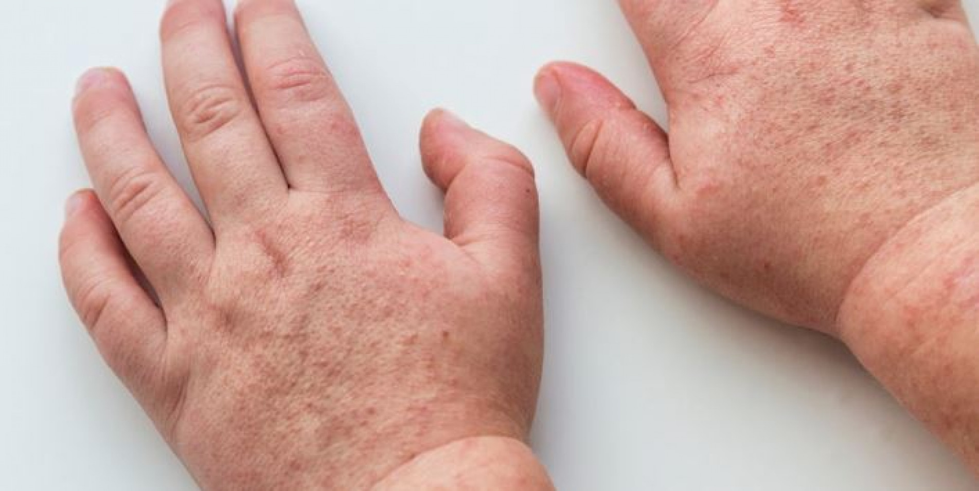  A erupção da escarlatina aparece por volta do segundo dia de doença, com início no pescoço e tronco, progredindo em direção à face e membros