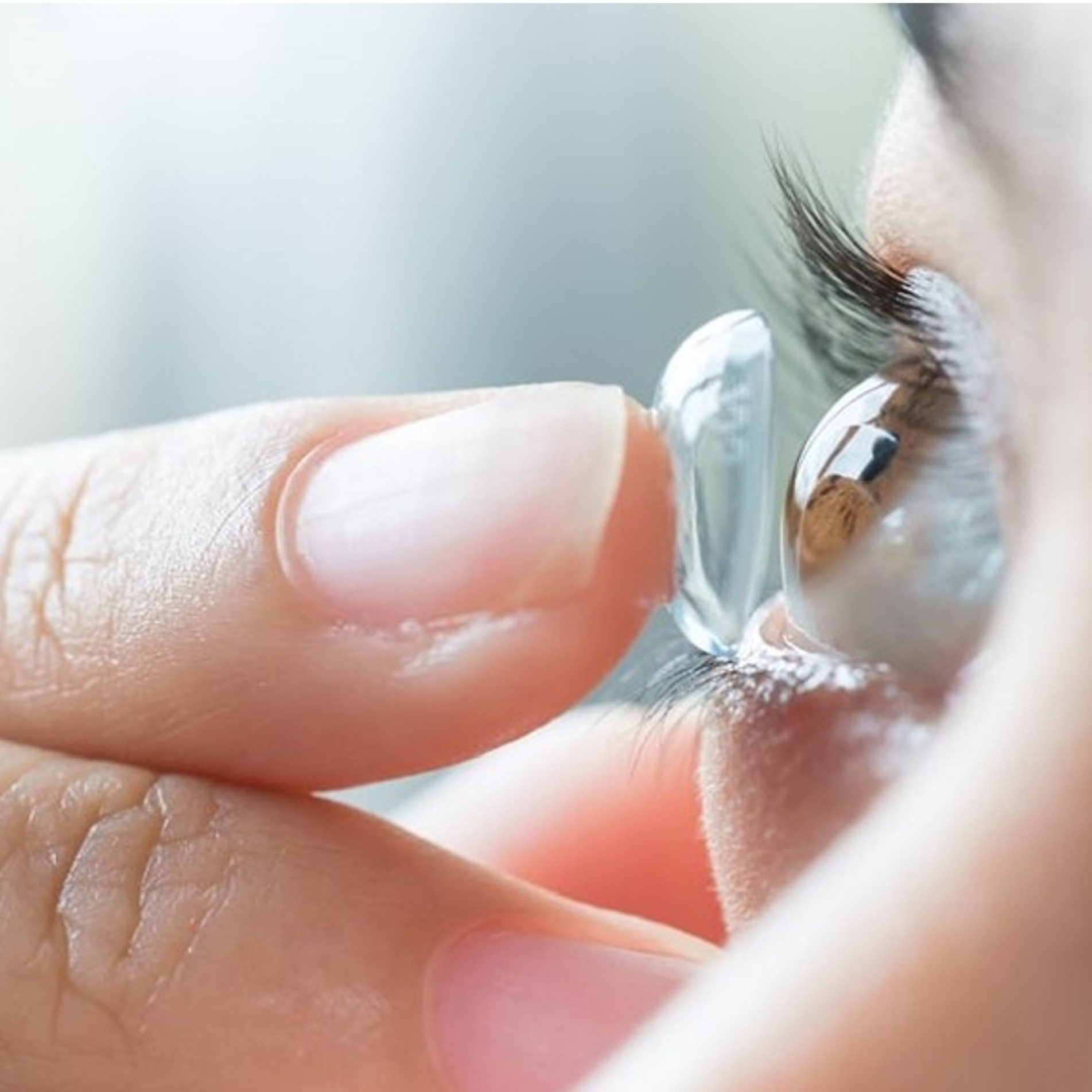 Conforme o ceratocone progride, são necessárias lentes rígidas para regular a superfície da córnea