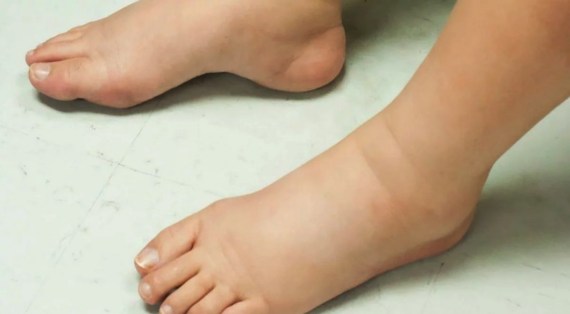 O inchaço dos pés é comum no verão, mas pode ser amenizado ou, mesmo, evitado 