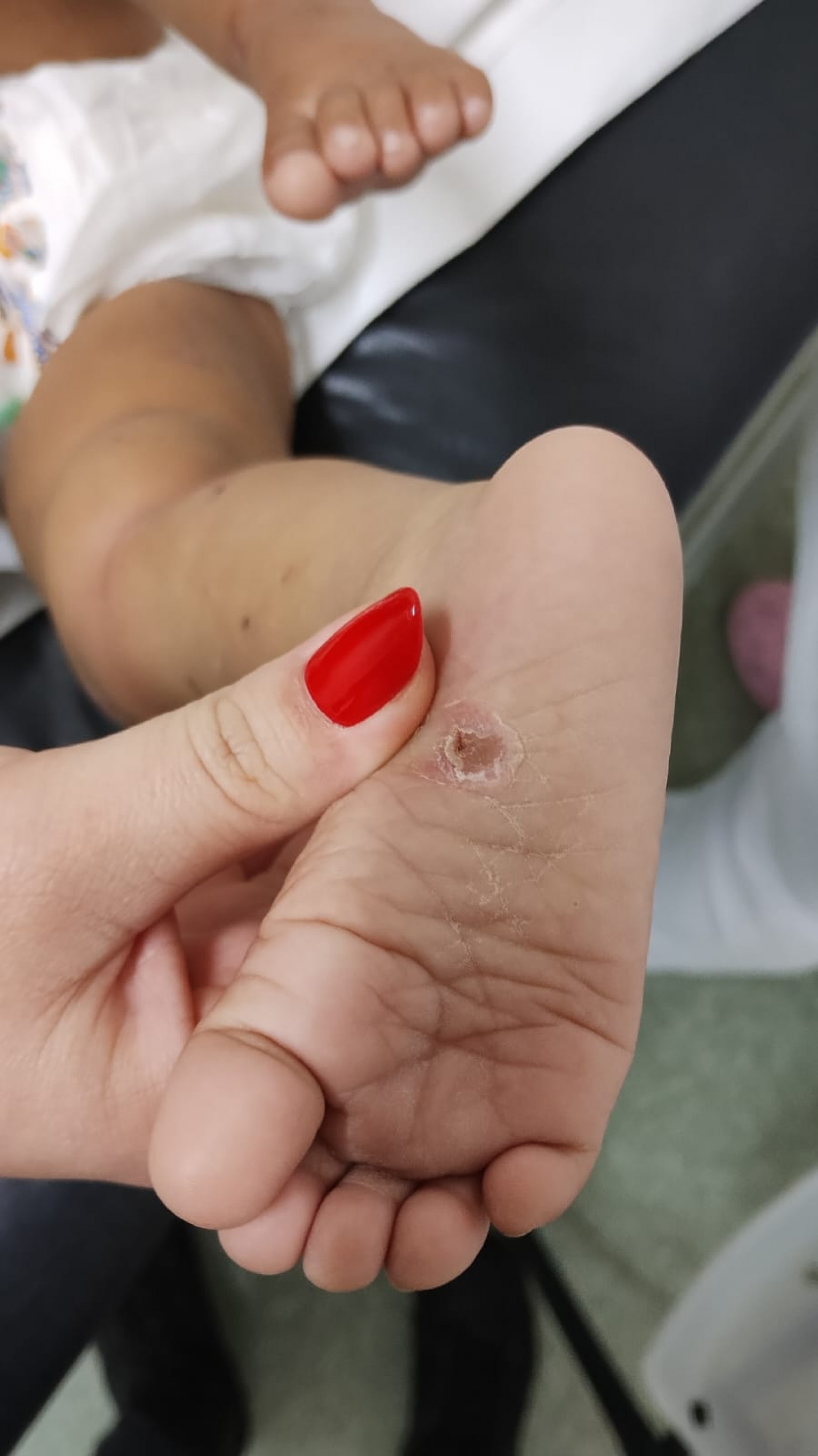 Queimadura causada possivelmente por cigarro