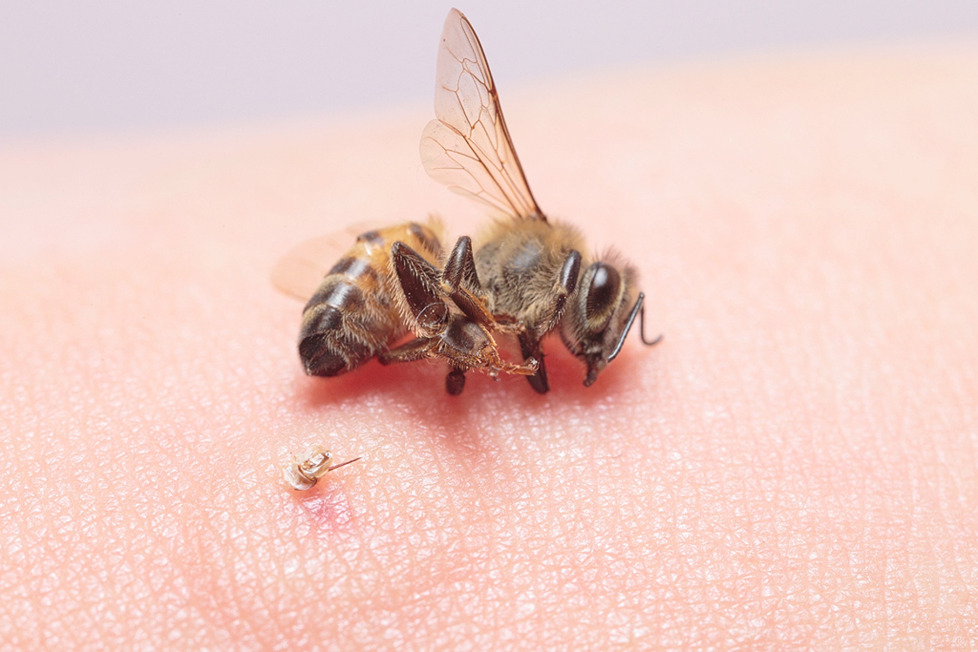 Inseto libera toxinas que levam a choque anafilático