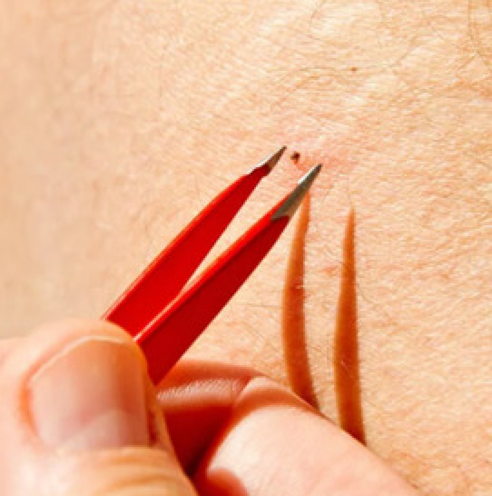 A doença é transmitida pelo carrapato