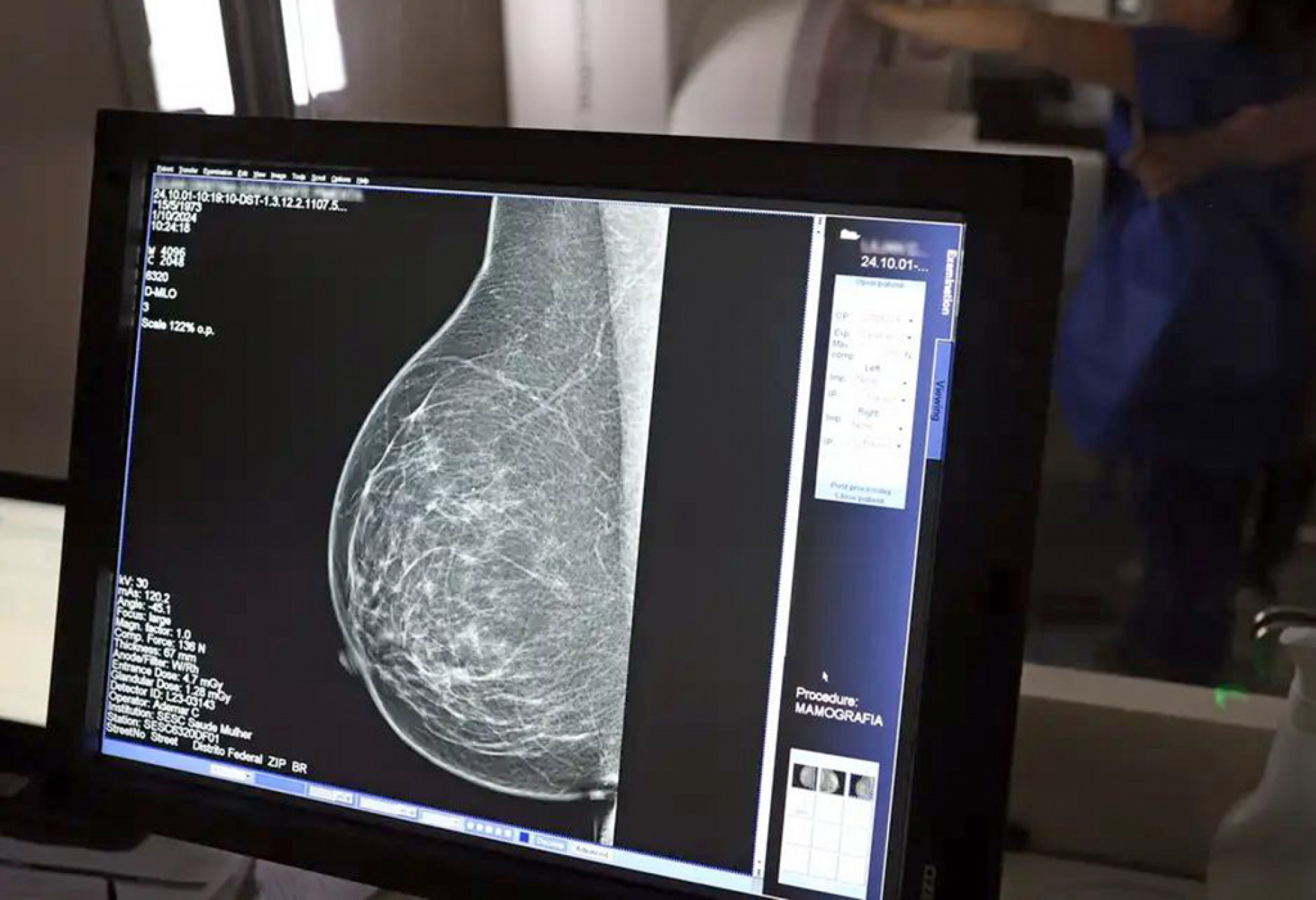 Exame é considerado fundamental para a detecção do câncer de mama
