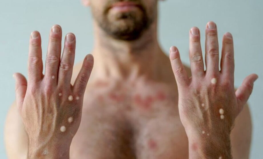 Segundo a Secretaria Municipal de Saúde, o rapaz havia sido internado na Santa Casa de Itu no sábado (29) e morreu na madrugada seguinte