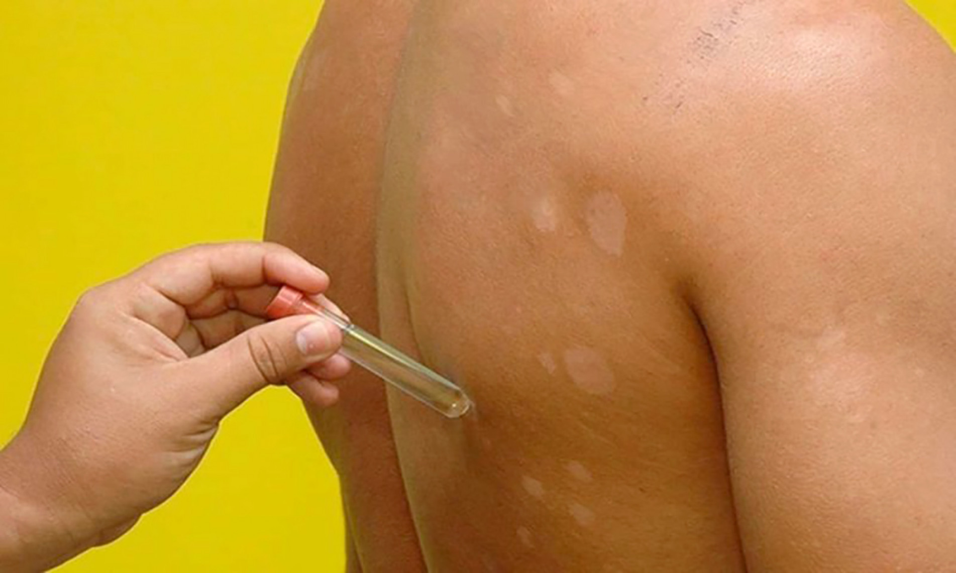 Notificações recentes reforçam ações de vigilância epidemiológica
