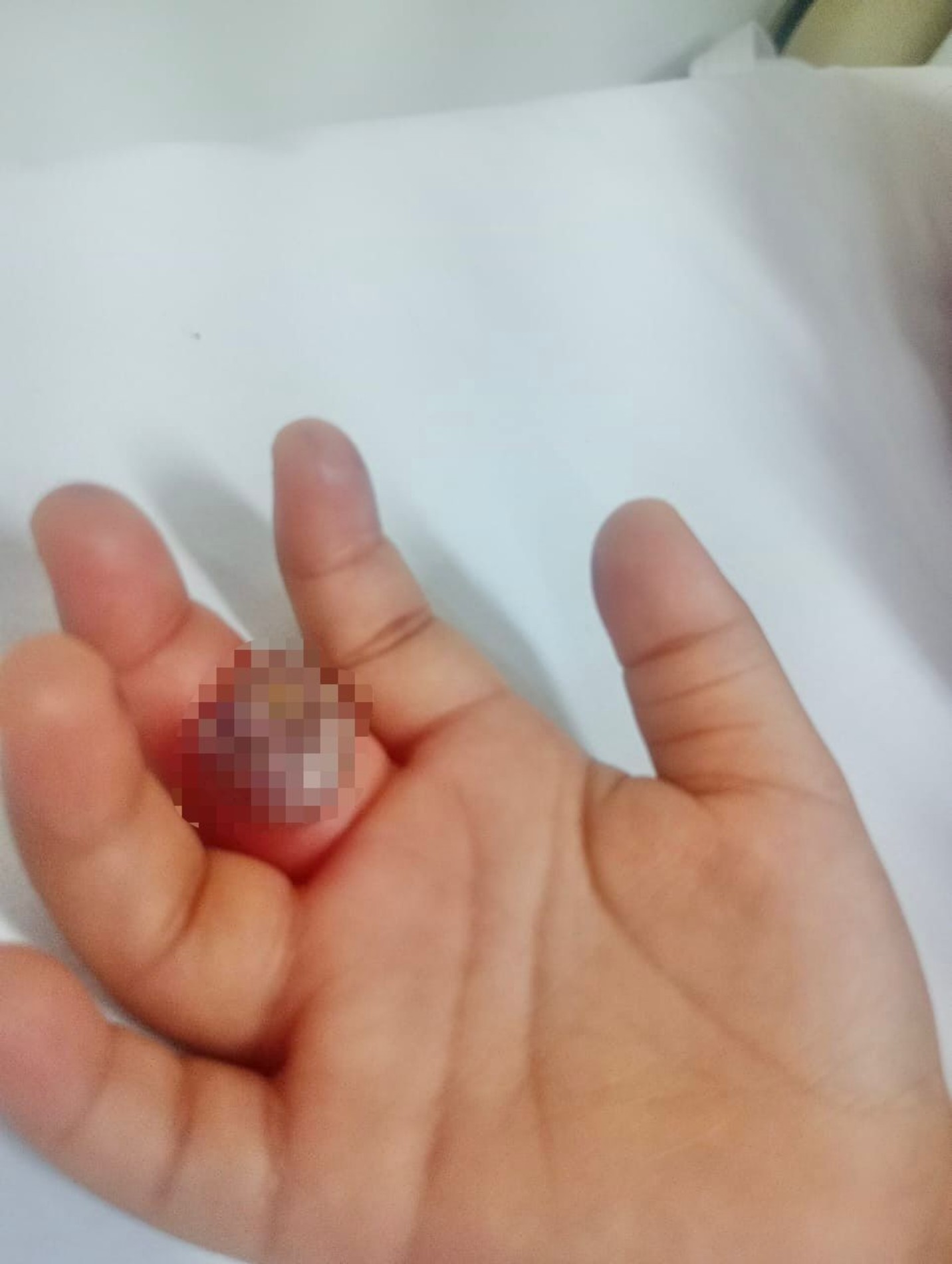 Criança precisou de drenagem e ficou em observação