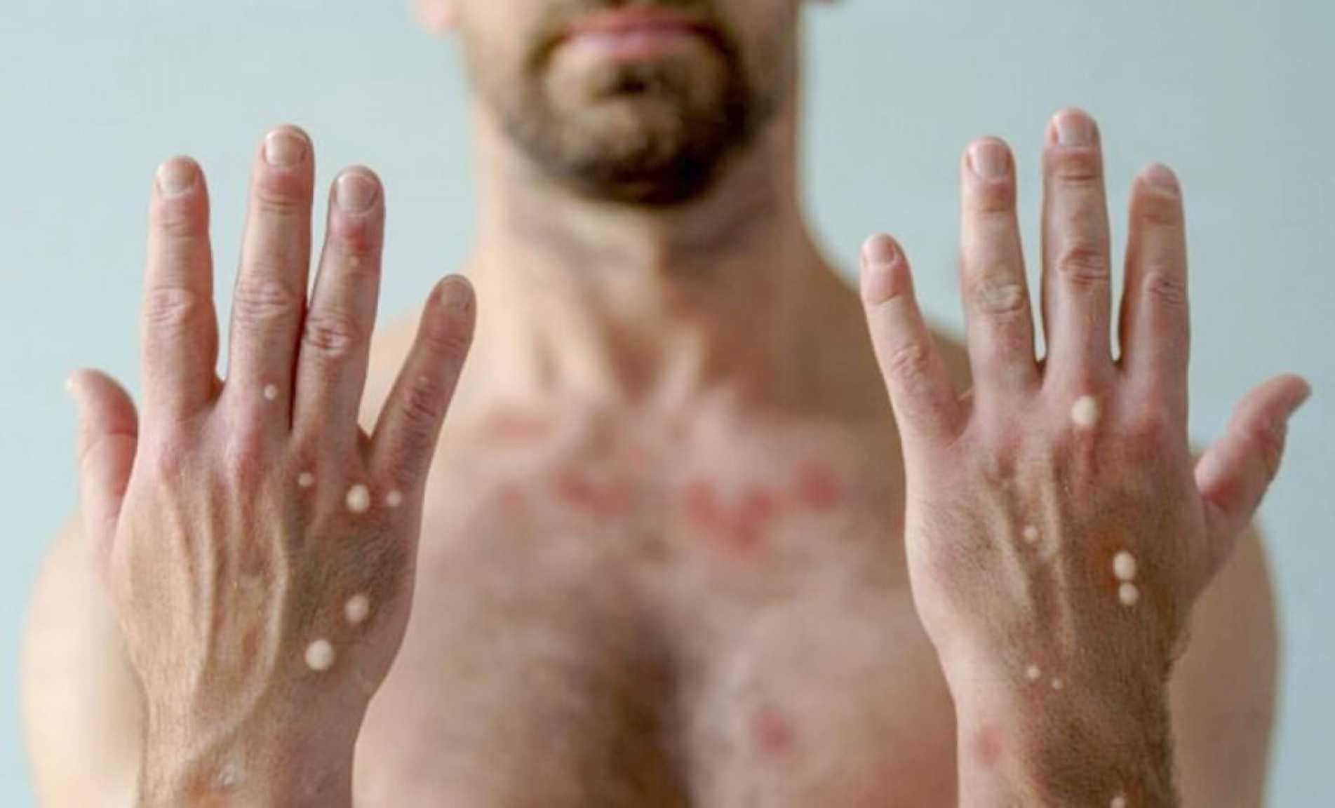 Erupções cutâneas são principal sintoma