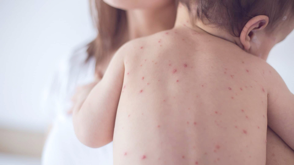  A vacina está disponível gratuitamente na rede pública e protege, prioritariamente, o público infantil